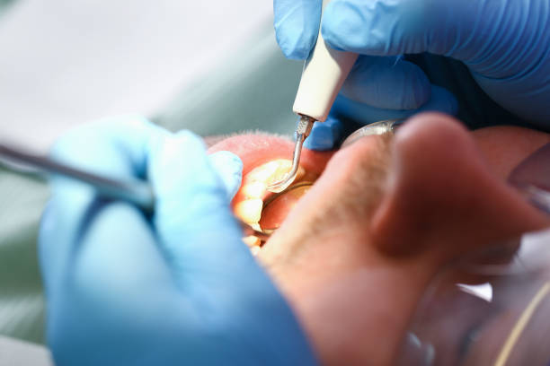 Best Emergency Root Canal Treatment in Sandersville, GA